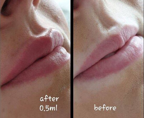 0.5 ml vs 1ml lip filler