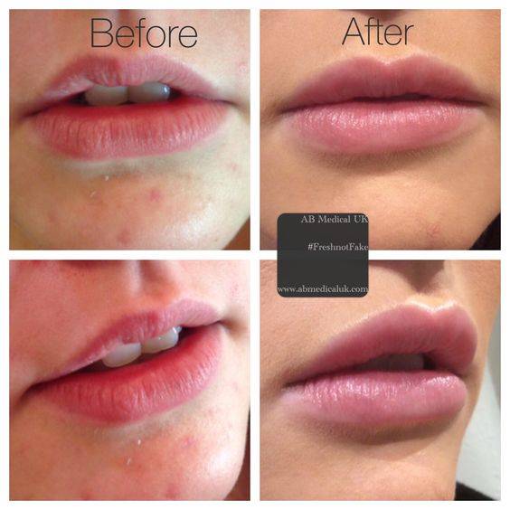 0.5 ml vs 1ml lip filler