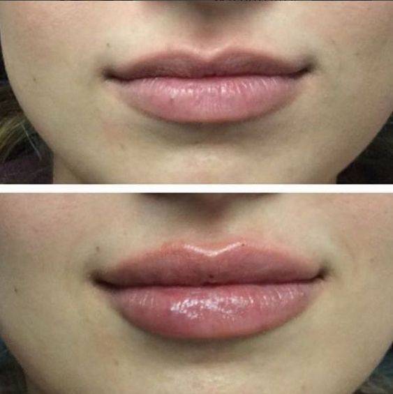 0.5 ml vs 1ml lip filler