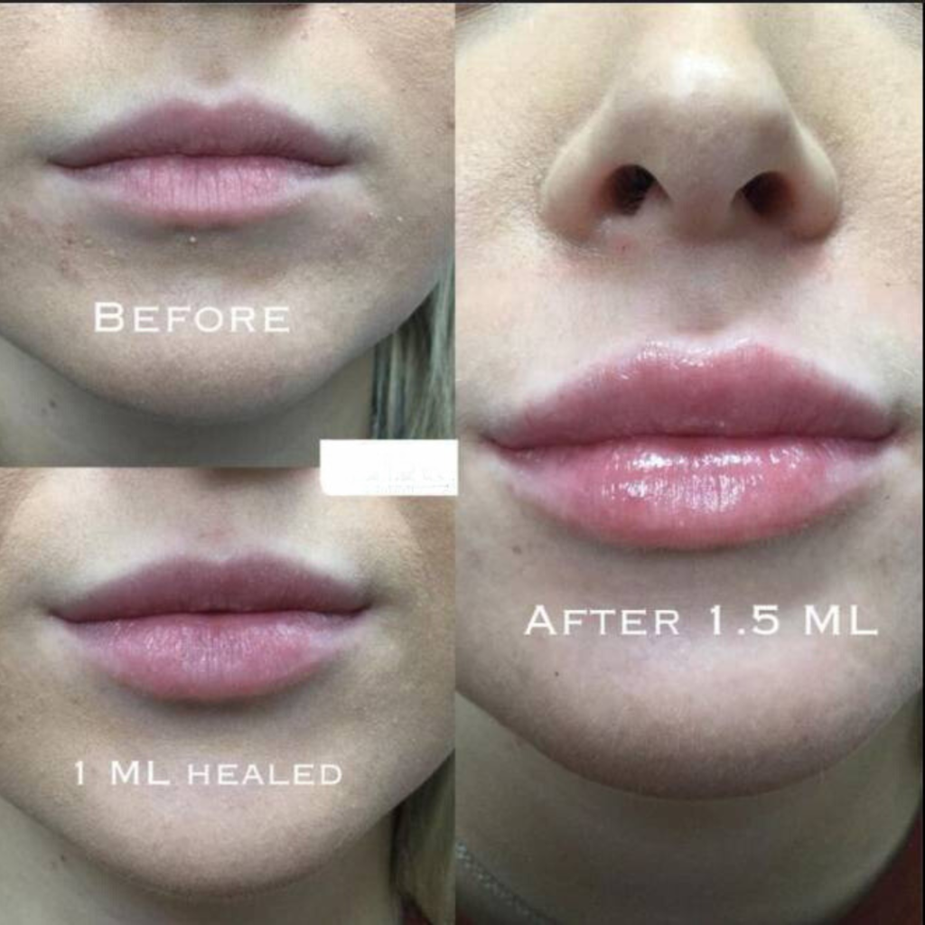 1 ml lip shape lip fillers