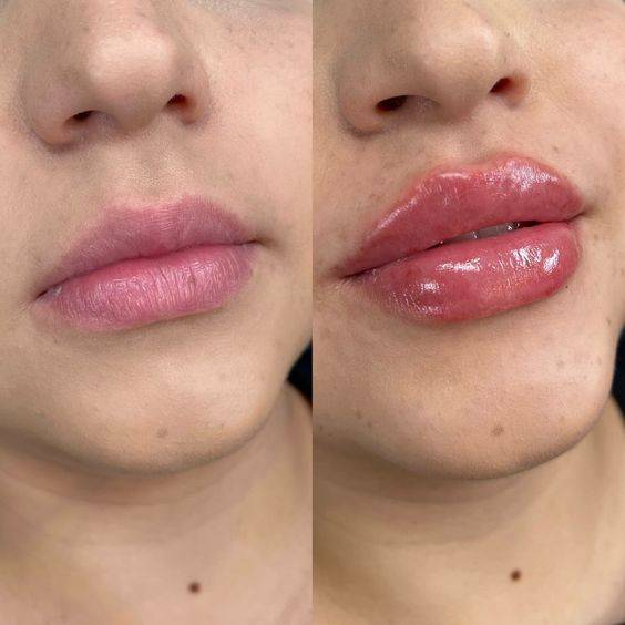 1ml lip filler for thin lips