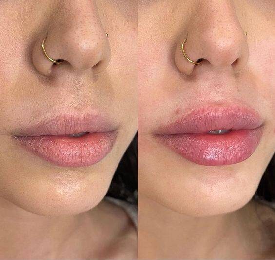 1ml lip filler for thin lips