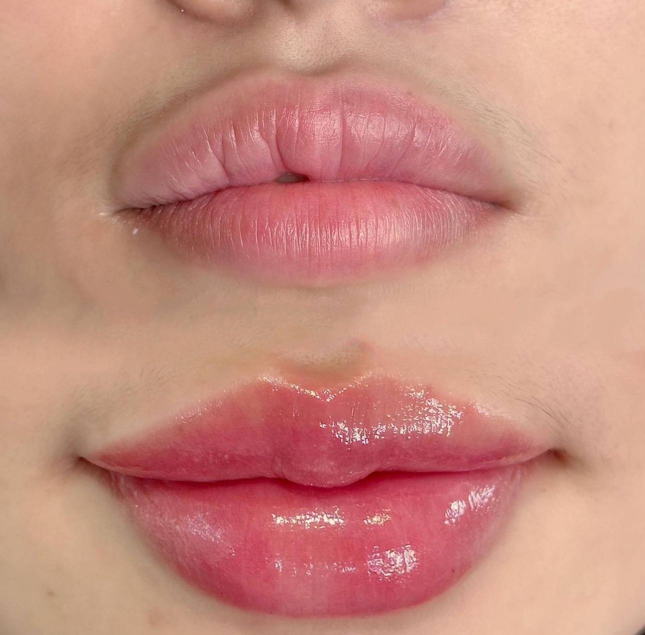 1ml natural lip fillers