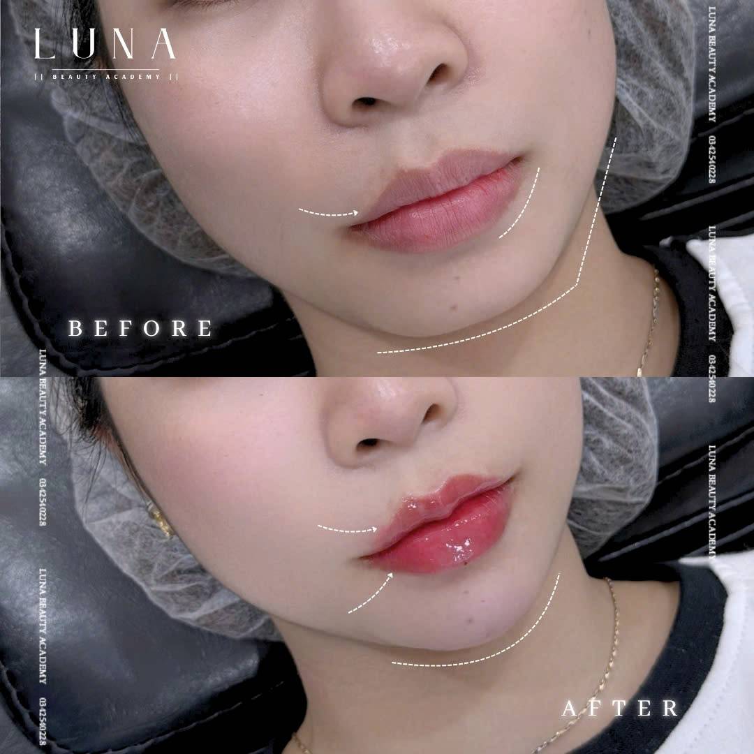 1ml natural lip fillers