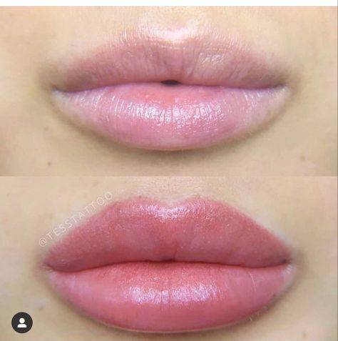 2ml lip filler