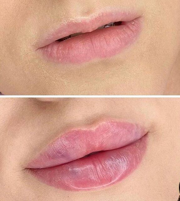 2ml lip filler