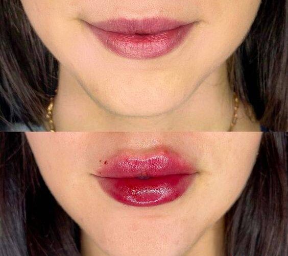 2ml lip filler