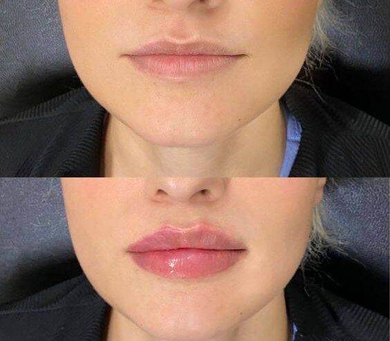 2ml lip filler