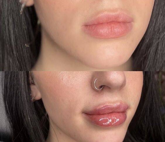 2ml lip filler