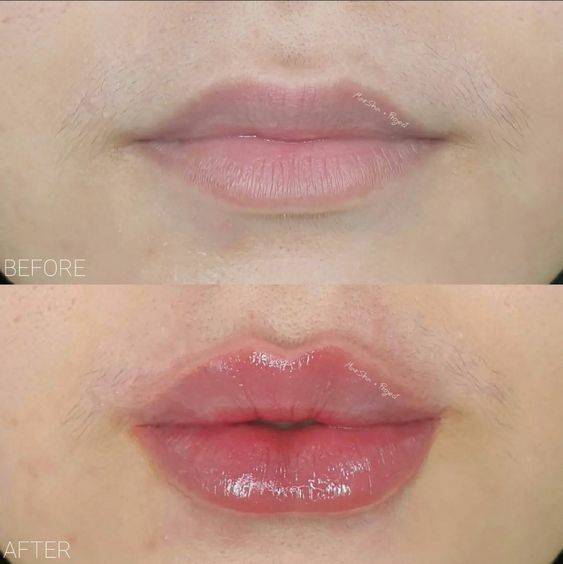 2ml lip filler