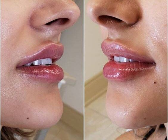 How Bad Does Lip Filler Hurt? When considering lip fillers, one of the common concerns is pain. Whether you’re contemplating your first lip filler treatment or you're looking for information to ease your anxiety