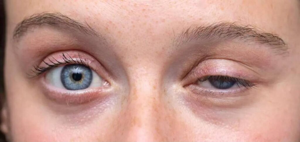 botox for droopy eyelid