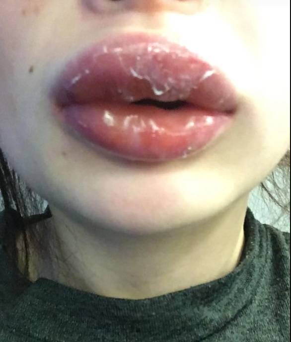 lips peeling after filler