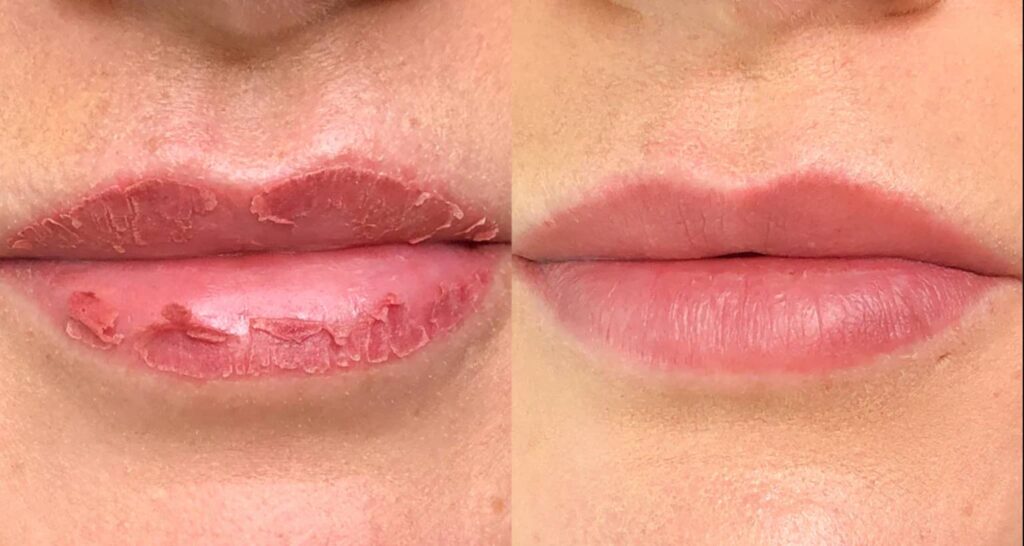 lips peeling after filler