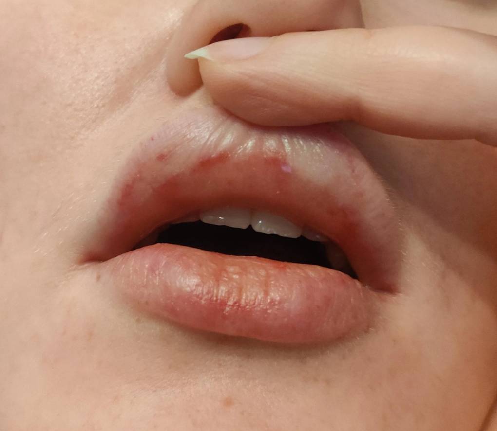 lips peeling after filler