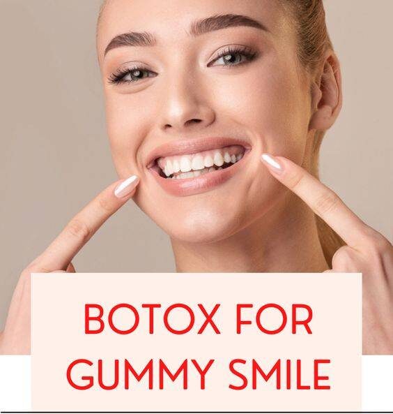 botox for gummy smile