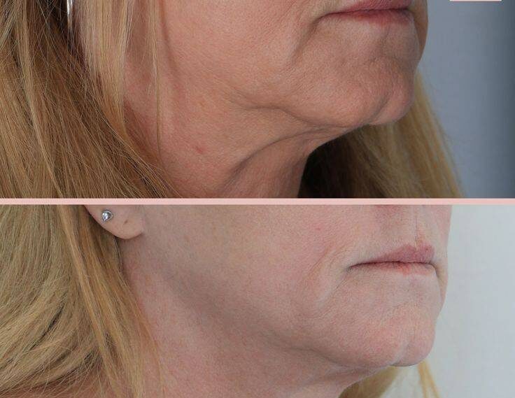 botox for jowls