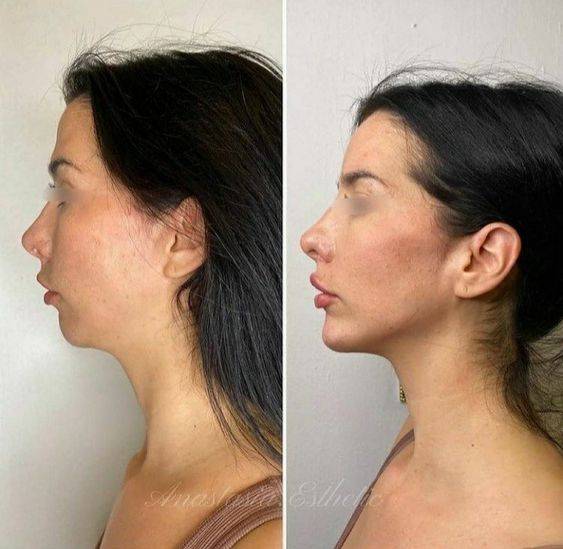 botox in chin