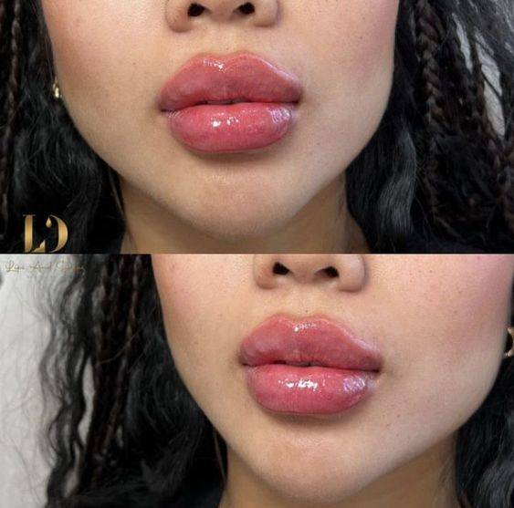 lips peeling after filler