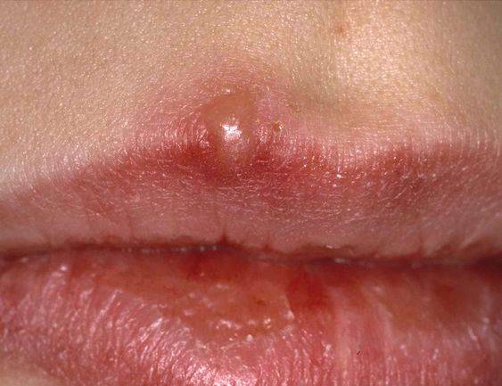 cold sores from lip injections