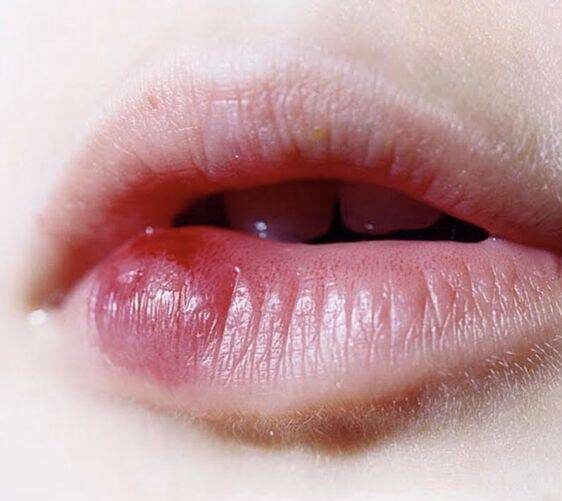 cold sores from lip injections