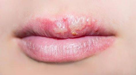 cold sores from lip injections