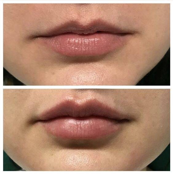 do lip fillers last longer the second time