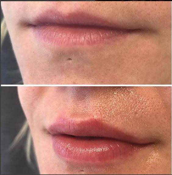 do lip fillers last longer the second time