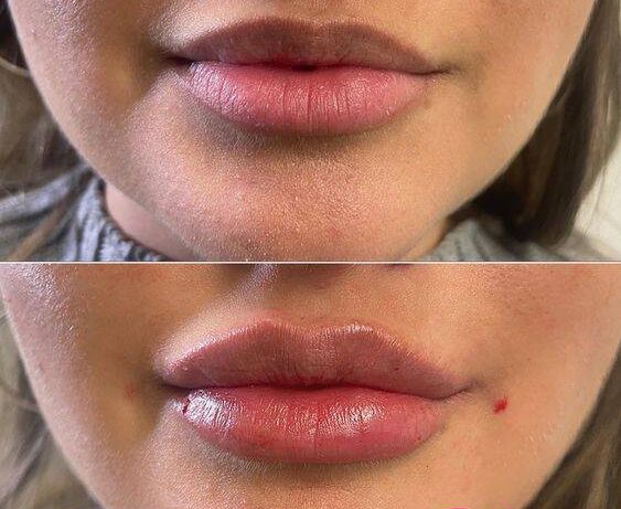 do lip fillers last longer the second time