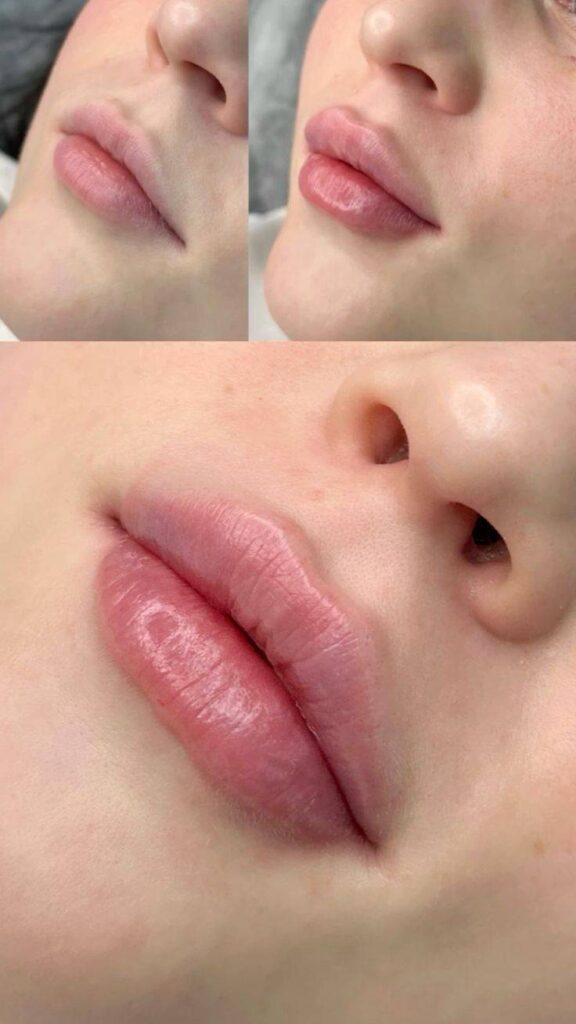 different types of lip fillers