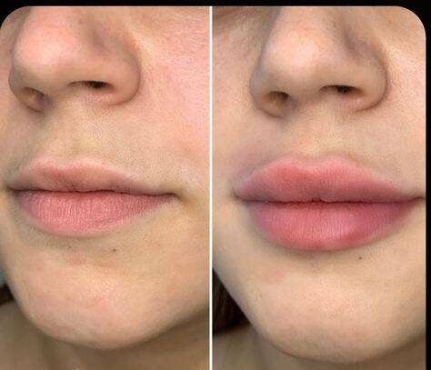 different types of lip fillers