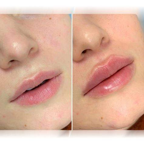 different types of lip fillers