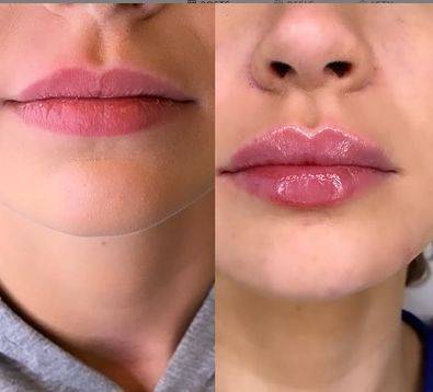 how do lip fillers work