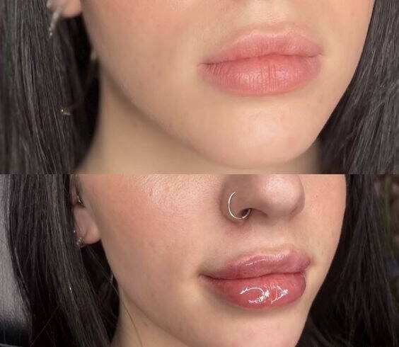 how long after lip filler can i use a straw