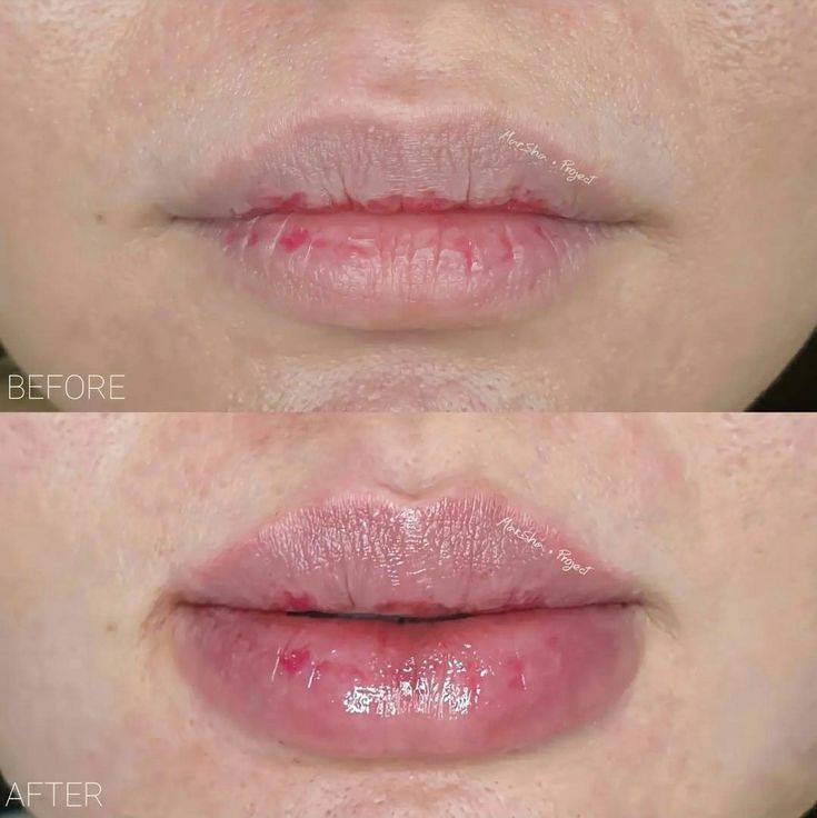 how long are lips swollen after filler