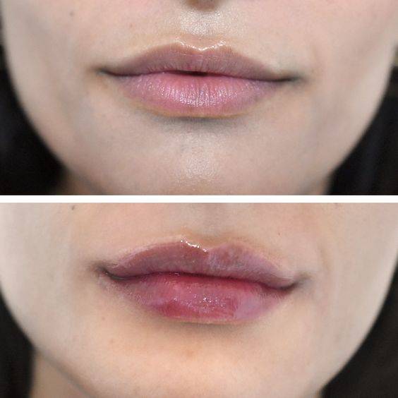 how long are lips swollen after filler