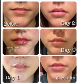 how long are lips swollen after filler