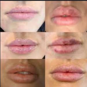 how long are lips swollen after filler