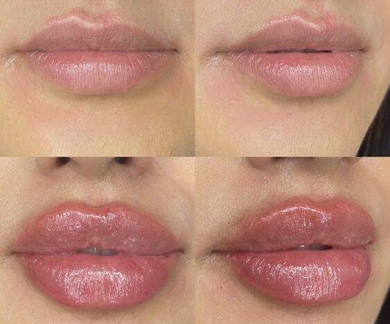 how long does it take for lip fillers to settle