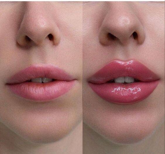 how long does it take for lip injections to settle