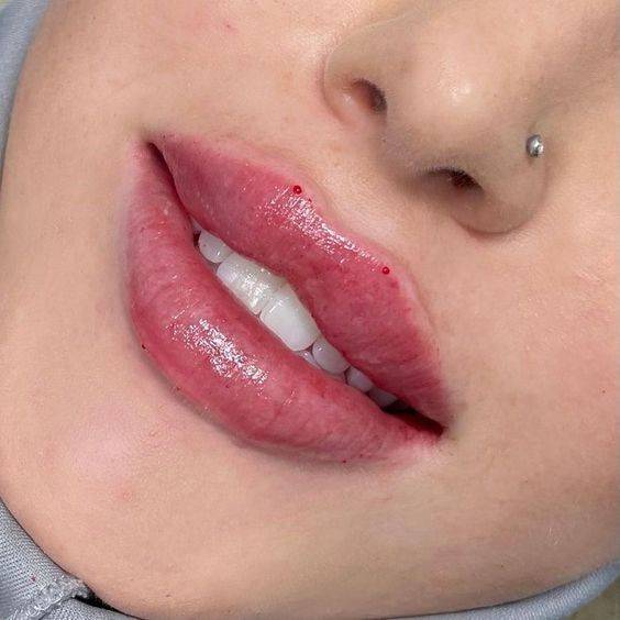 how long does juvederm last in lips