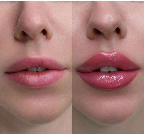 how long does juvederm last in lips