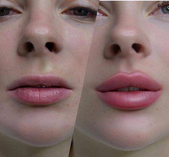 how long does juvederm last in lips