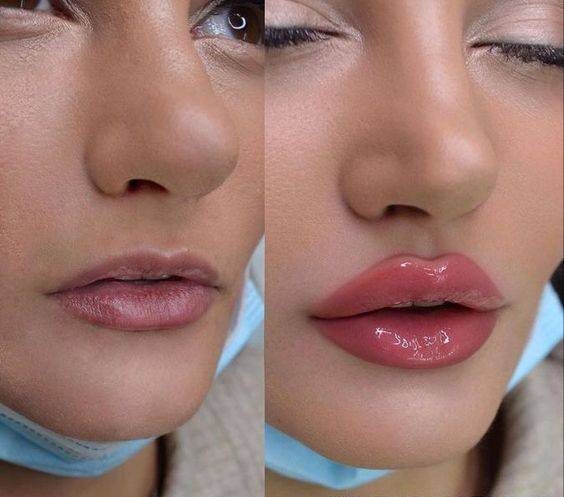 how long does juvederm last in lips