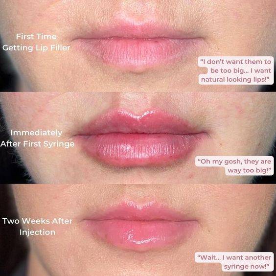 how long does lip filler swelling last