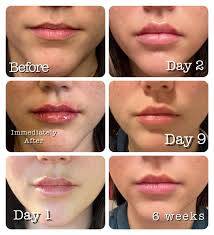 how long does swelling last after lip filler