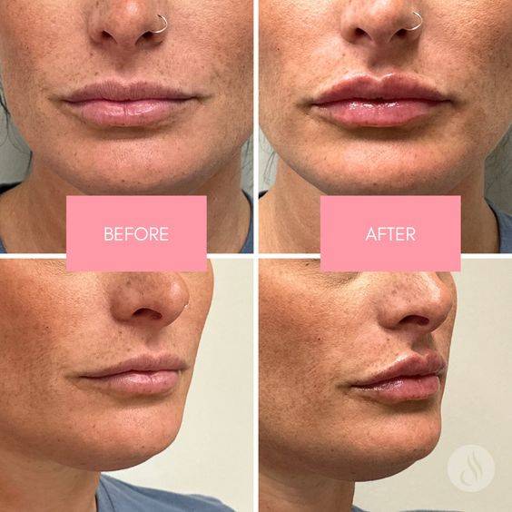 how long does swelling last after lip filler