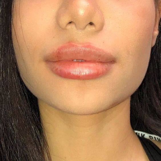 how long does swelling last after lip filler