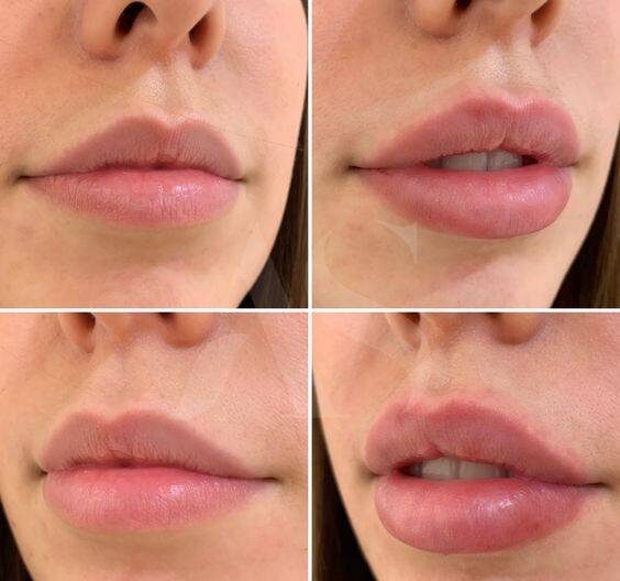 how long does swelling last after lip filler