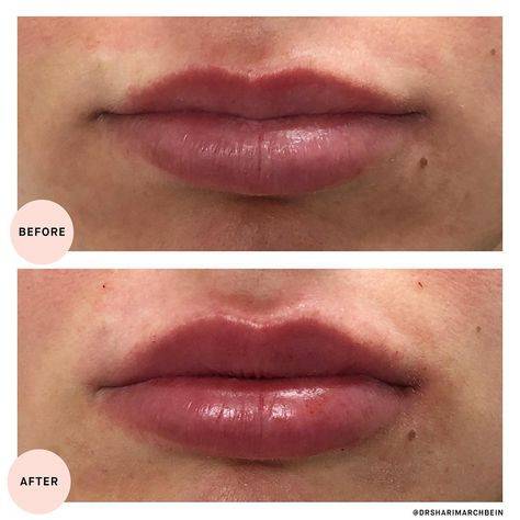 lip filler healing stages